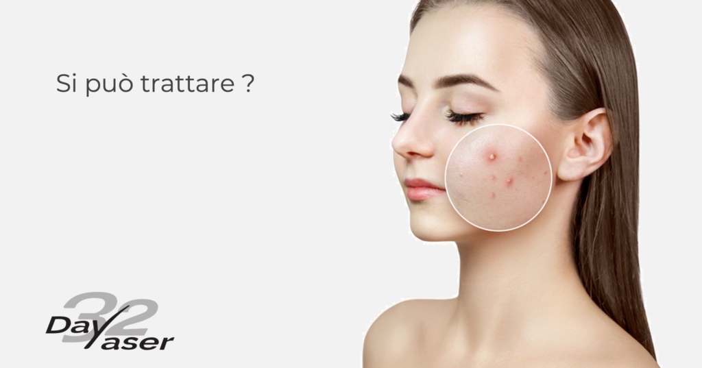 Acne in fase attiva