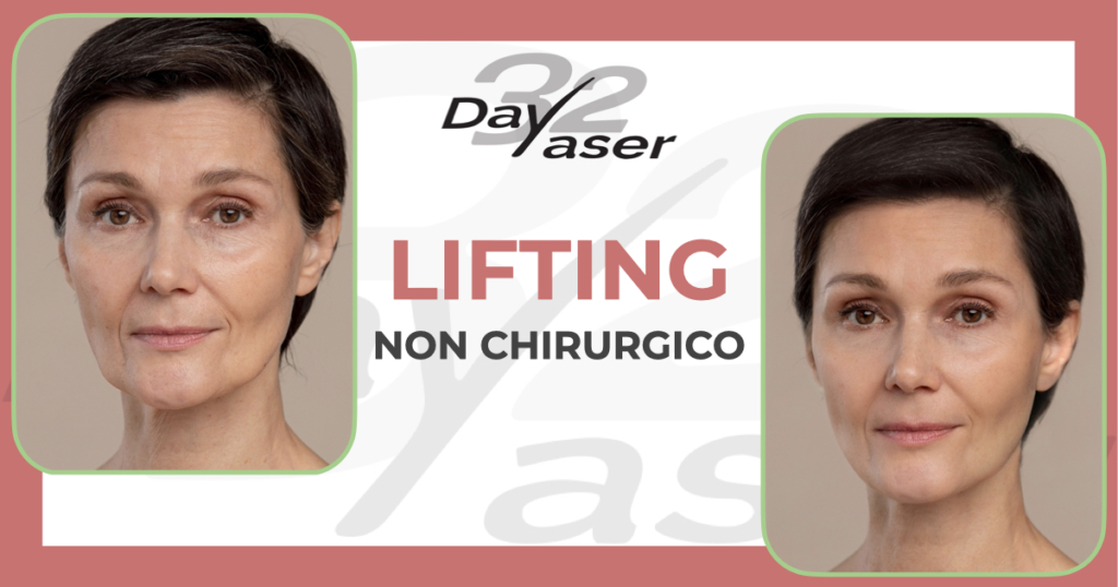 Ultraformer 3 HIFU: lifting non chirurgico